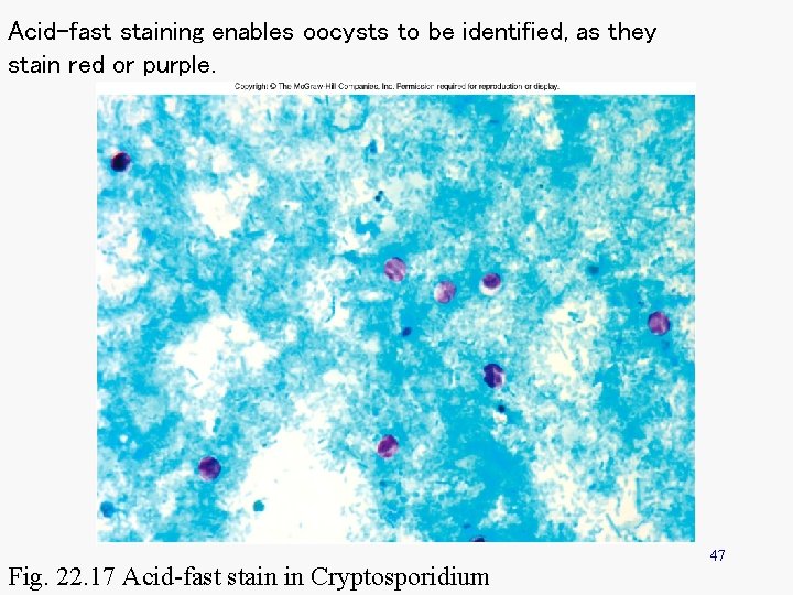 Acid-fast staining enables oocysts to be identified, as they stain red or purple. Fig.