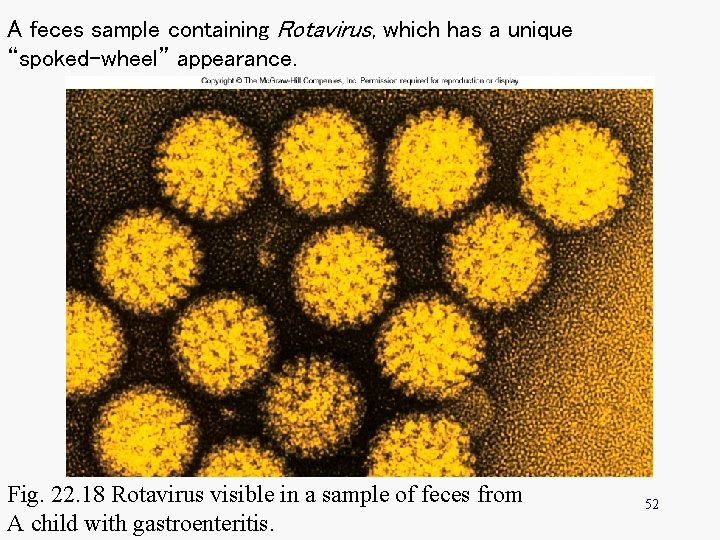 A feces sample containing Rotavirus, which has a unique “spoked-wheel” appearance. Fig. 22. 18