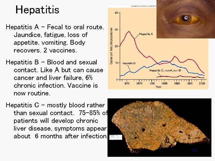 Hepatitis A – Fecal to oral route. Jaundice, fatigue, loss of appetite, vomiting. Body