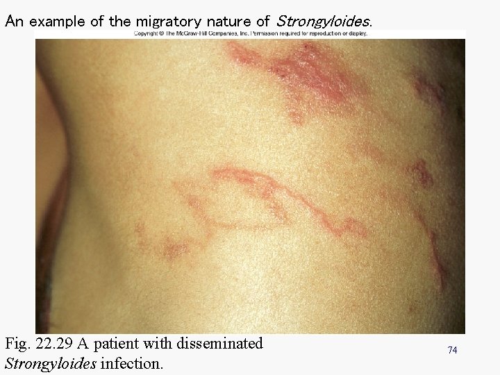 An example of the migratory nature of Strongyloides. Fig. 22. 29 A patient with