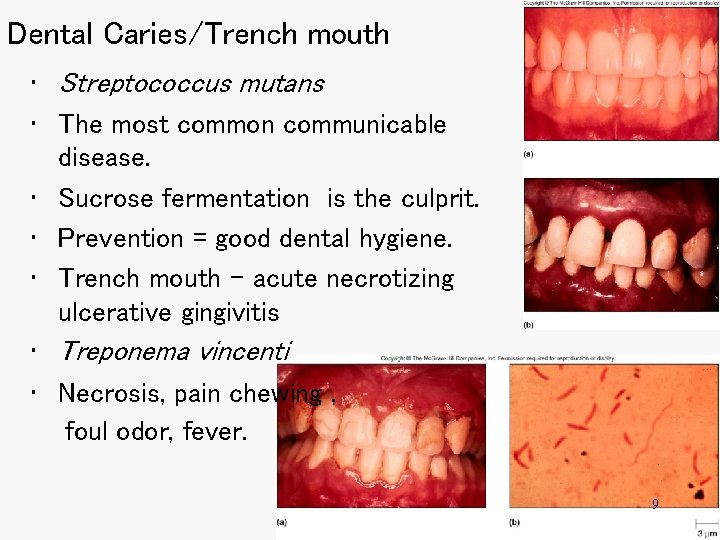 Dental Caries/Trench mouth • Streptococcus mutans • The most common communicable disease. • Sucrose