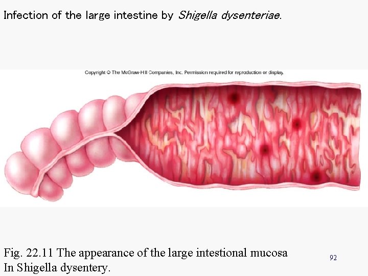 Infection of the large intestine by Shigella dysenteriae. Fig. 22. 11 The appearance of