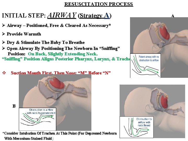 RESUSCITATION PROCESS INITIAL STEP: AIRWAY (Strategy A) A Ø Airway – Positioned, Free &