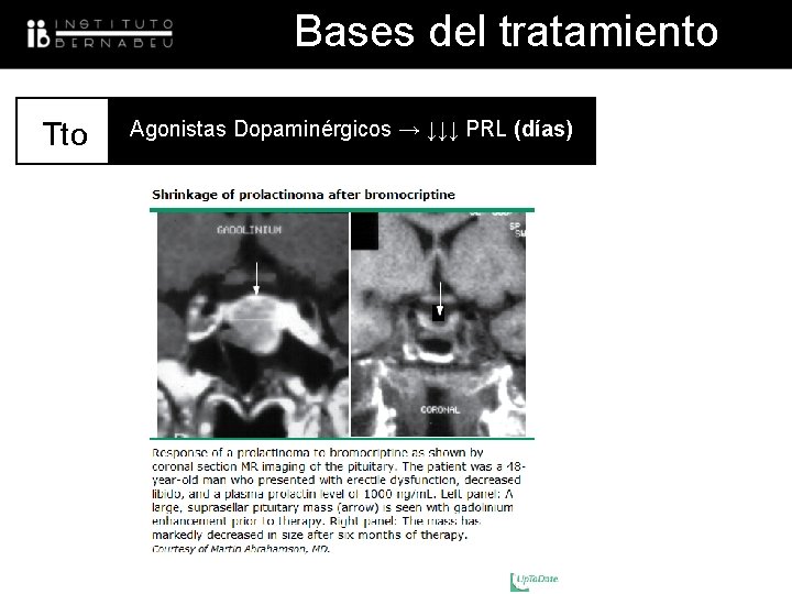 Bases del tratamiento Tto UNIDAD BAJA Agonistas Dopaminérgicos → ↓↓↓ PRL RESPONDEDORA (días) 