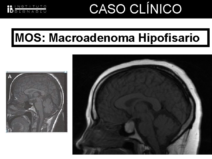 CASO CLÍNICO MOS: Macroadenoma Hipofisario 