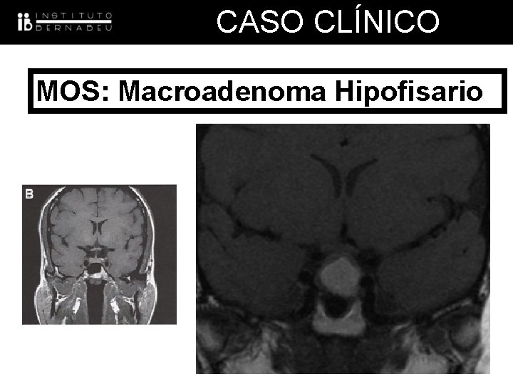 CASO CLÍNICO MOS: Macroadenoma Hipofisario 