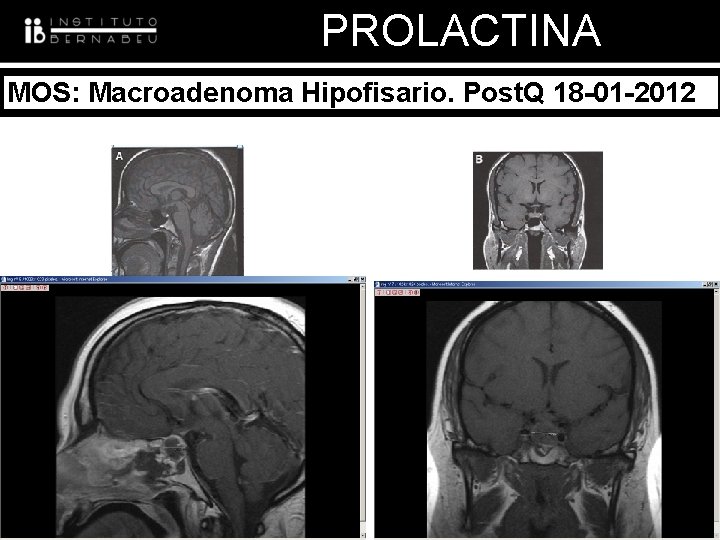 PROLACTINA MOS: Macroadenoma Hipofisario. Post. Q 18 -01 -2012 