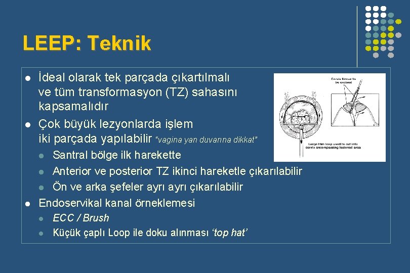 LEEP: Teknik l l İdeal olarak tek parçada çıkartılmalı ve tüm transformasyon (TZ) sahasını