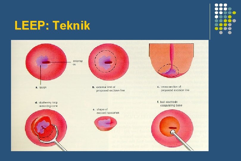 LEEP: Teknik 