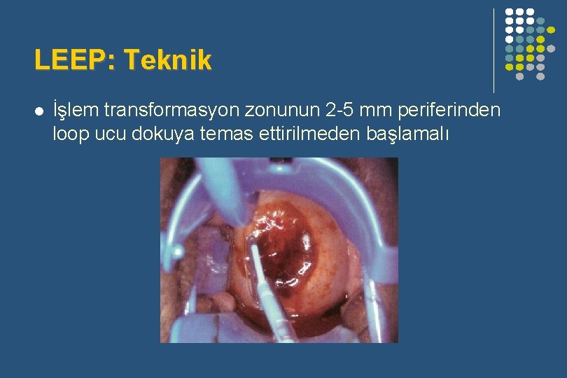 LEEP: Teknik l İşlem transformasyon zonunun 2 -5 mm periferinden loop ucu dokuya temas