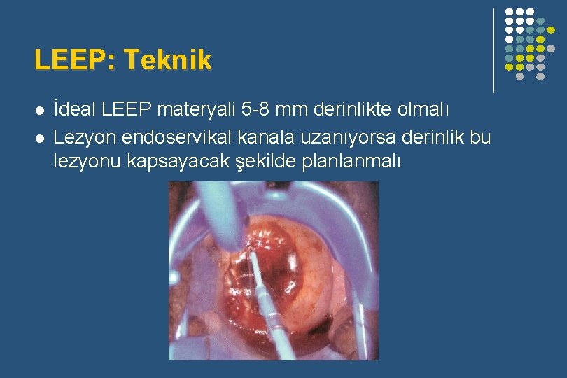 LEEP: Teknik l l İdeal LEEP materyali 5 -8 mm derinlikte olmalı Lezyon endoservikal