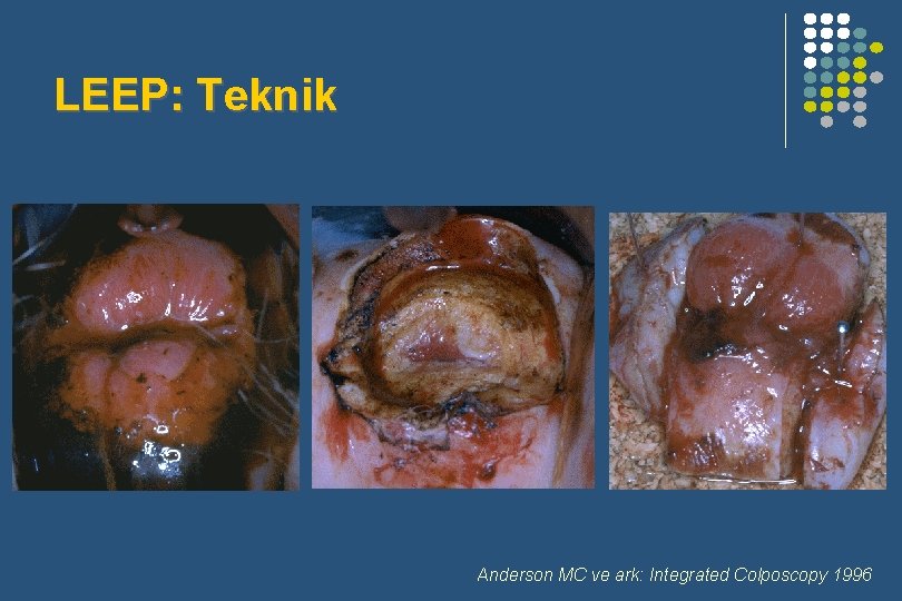 LEEP: Teknik Anderson MC ve ark: Integrated Colposcopy 1996 