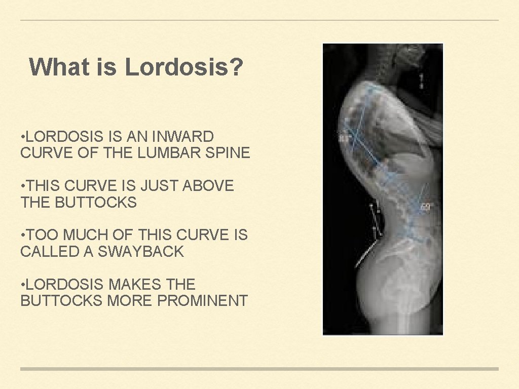 What is Lordosis? • LORDOSIS IS AN INWARD CURVE OF THE LUMBAR SPINE •