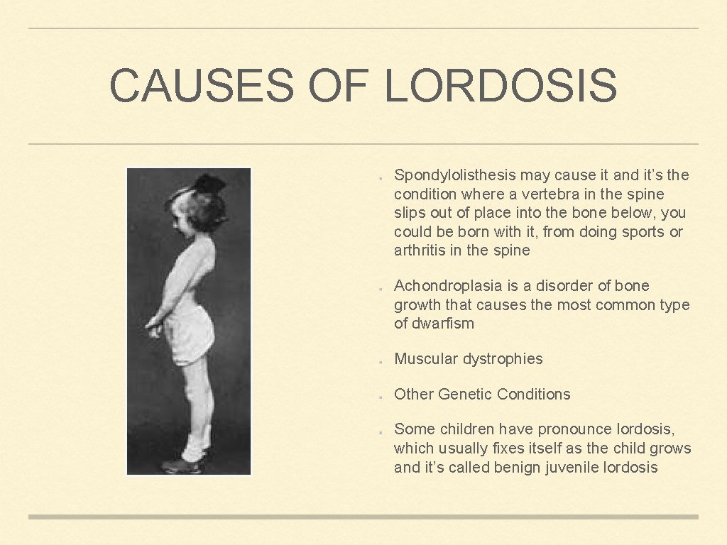 CAUSES OF LORDOSIS Spondylolisthesis may cause it and it’s the condition where a vertebra