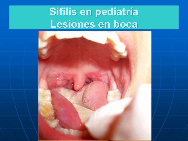 Sífilis en pediatría Lesiones en boca 