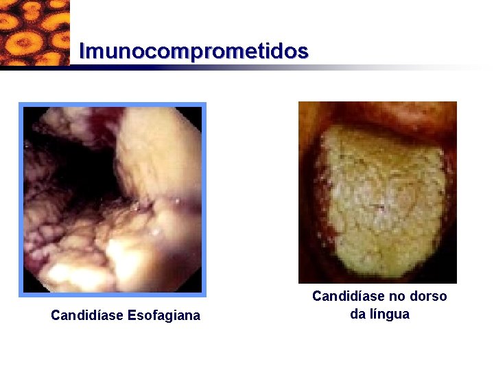 Imunocomprometidos Candidíase Esofagiana Candidíase no dorso da língua 