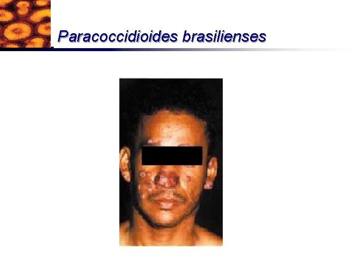 Paracoccidioides brasilienses 