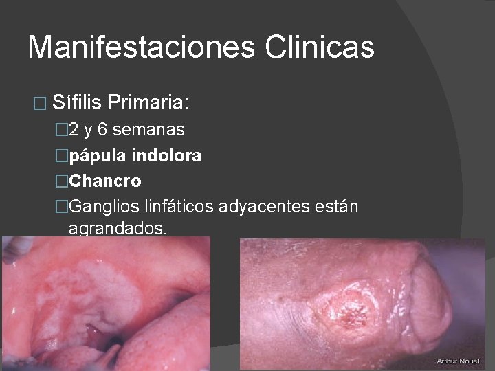 Manifestaciones Clinicas � Sífilis Primaria: � 2 y 6 semanas �pápula indolora �Chancro �Ganglios