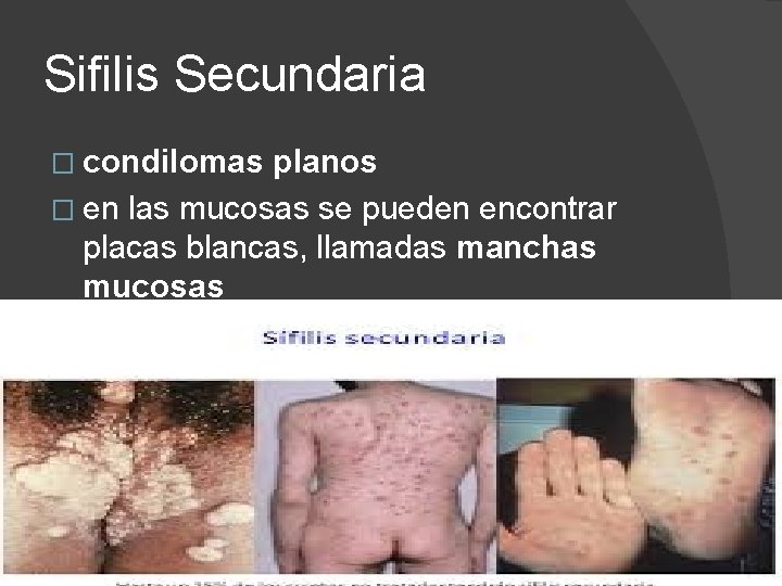 Sifilis Secundaria � condilomas planos � en las mucosas se pueden encontrar placas blancas,