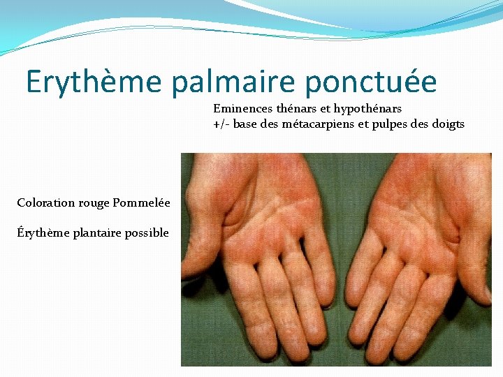 Erythème palmaire ponctuée Eminences thénars et hypothénars +/- base des métacarpiens et pulpes doigts