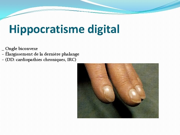 Hippocratisme digital _ Ongle biconvexe – Élargissement de la dernière phalange – (DD: cardiopathies