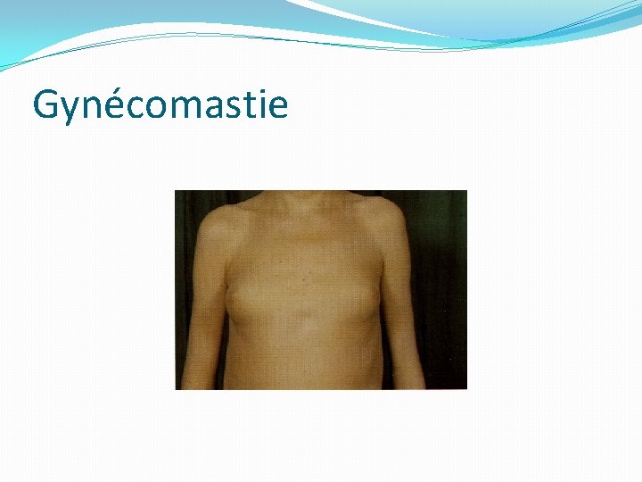 Gynécomastie 