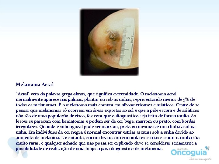 Melanoma Acral "Acral" vem da palavra grega akron, que significa extremidade. O melanoma acral