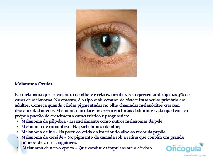 Melanoma Ocular É o melanoma que se encontra no olho e é relativamente raro,
