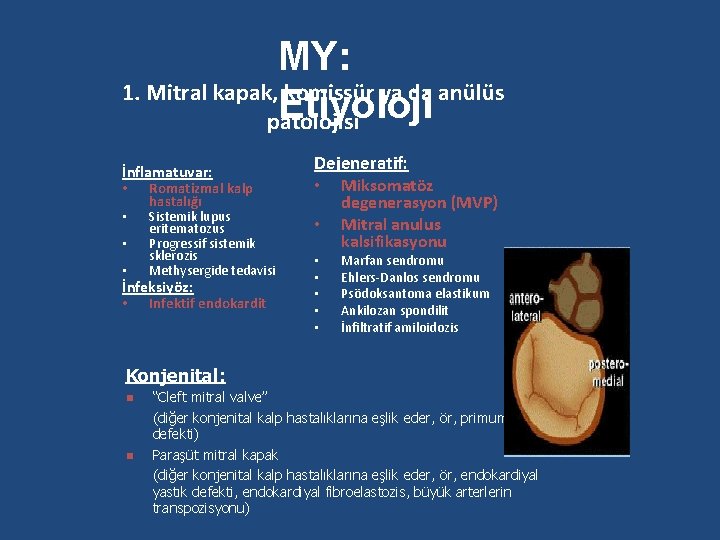 MY: 1. Mitral kapak, komissür ya da anülüs Etiyoloji patolojisi İnflamatuvar: • Romatizmal kalp