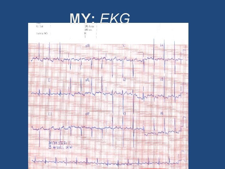 MY: EKG 