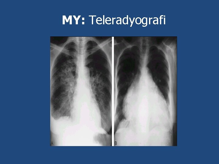 MY: Teleradyografi 