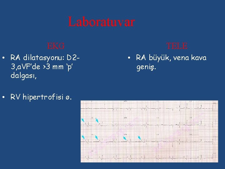 Laboratuvar EKG • RA dilatasyonu: D 23, a. VF’de >3 mm ‘p’ dalgası, •