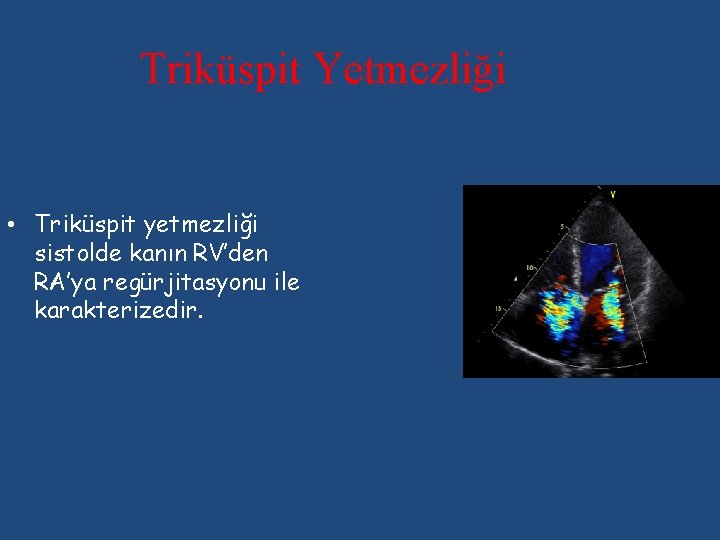 Triküspit Yetmezliği • Triküspit yetmezliği sistolde kanın RV’den RA’ya regürjitasyonu ile karakterizedir. 