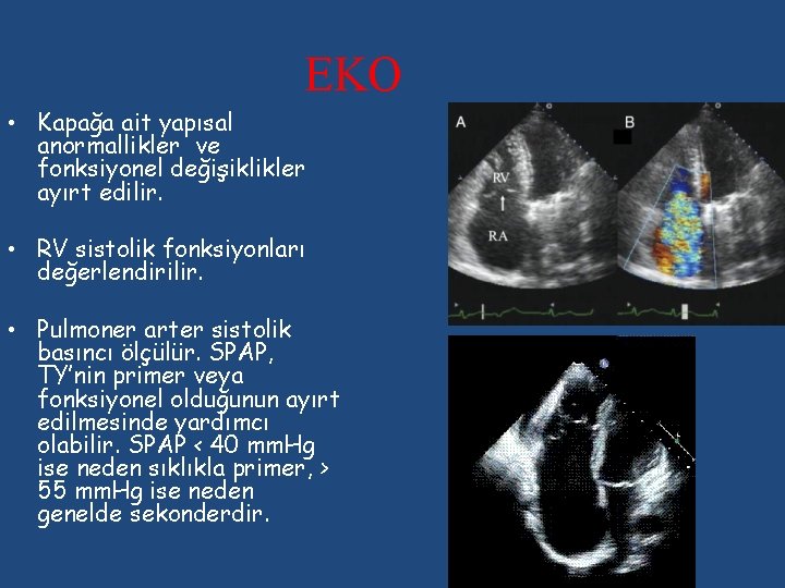 EKO • Kapağa ait yapısal anormallikler ve fonksiyonel değişiklikler ayırt edilir. • RV sistolik