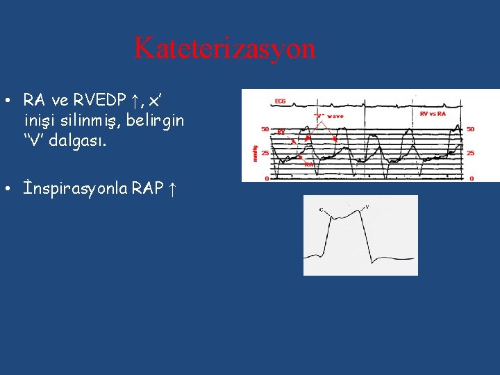 Kateterizasyon • RA ve RVEDP ↑, x’ inişi silinmiş, belirgin ‘‘v’’ dalgası. • İnspirasyonla