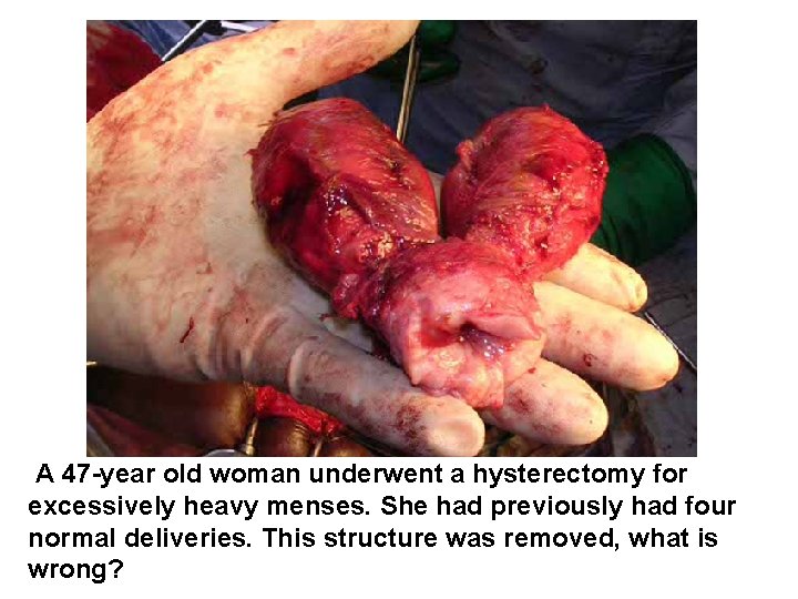 A 47 -year old woman underwent a hysterectomy for excessively heavy menses. She had