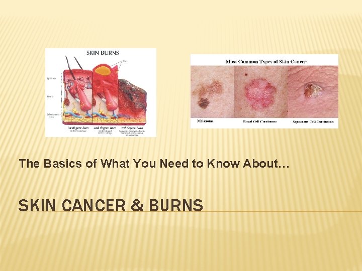 The Basics of What You Need to Know About… SKIN CANCER & BURNS 