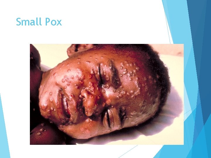 Small Pox 