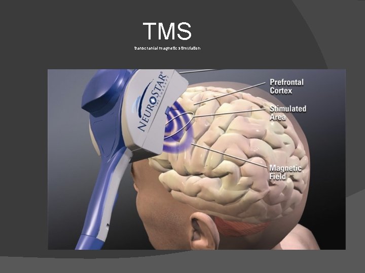 TMS transcranial magnetic stimulation 