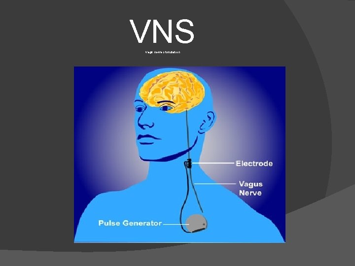 VNS vagil nerve stimulation 