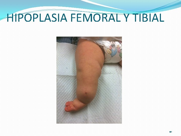 HIPOPLASIA FEMORAL Y TIBIAL 10 HIPOPLASIA FEMORAL Y TIBIAL 10