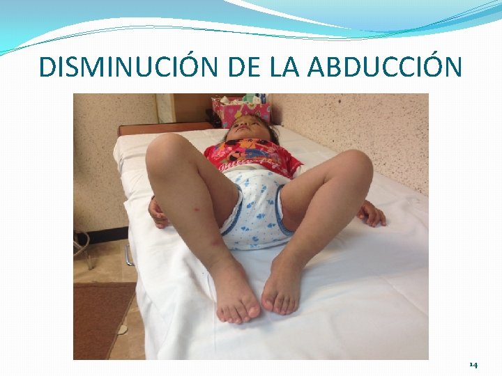 DISMINUCIÓN DE LA ABDUCCIÓN 14 DISMINUCIÓN DE LA ABDUCCIÓN 14