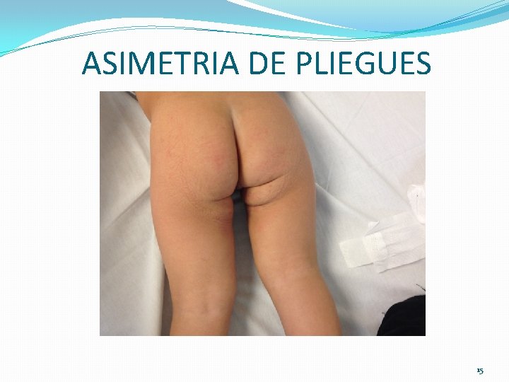 ASIMETRIA DE PLIEGUES 15 ASIMETRIA DE PLIEGUES 15