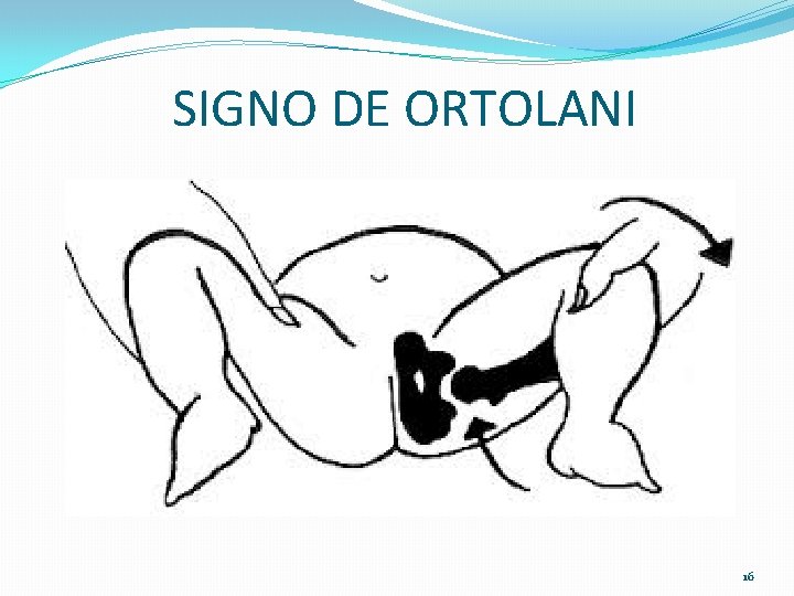 SIGNO DE ORTOLANI 16 SIGNO DE ORTOLANI 16