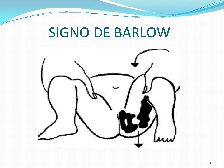 SIGNO DE BARLOW 17 SIGNO DE BARLOW 17