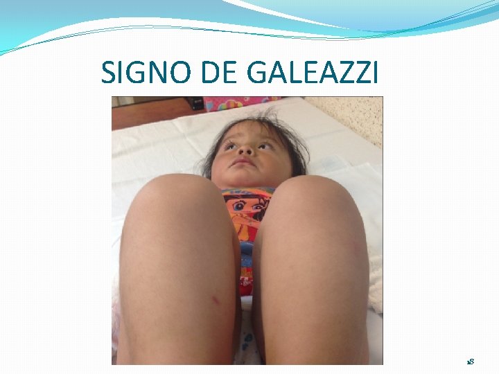 SIGNO DE GALEAZZI 18 SIGNO DE GALEAZZI 18
