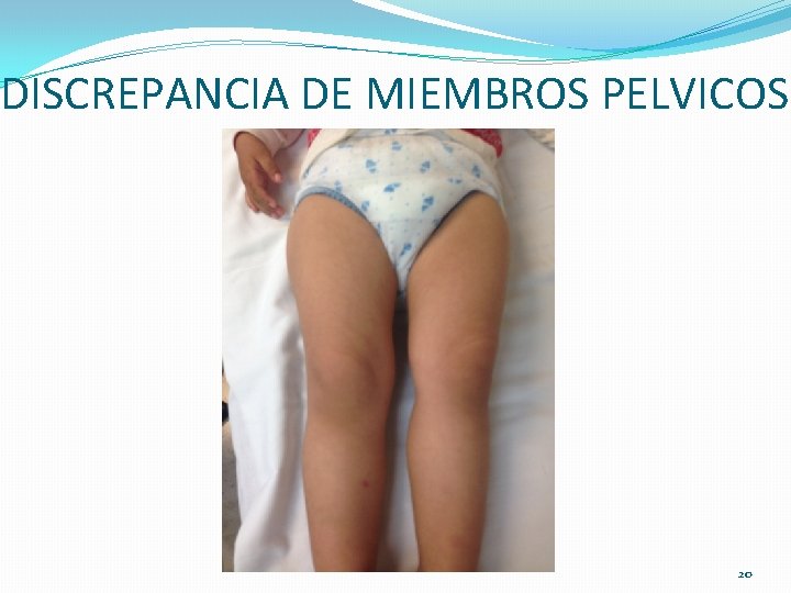 DISCREPANCIA DE MIEMBROS PELVICOS 20 DISCREPANCIA DE MIEMBROS PELVICOS 20