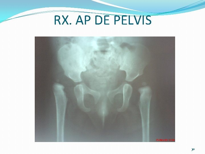 RX. AP DE PELVIS 30 RX. AP DE PELVIS 30