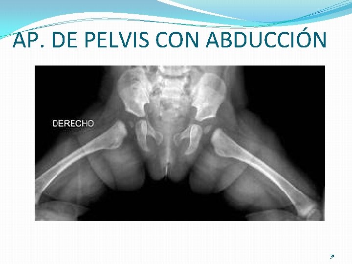 AP. DE PELVIS CON ABDUCCIÓN 31 AP. DE PELVIS CON ABDUCCIÓN 31