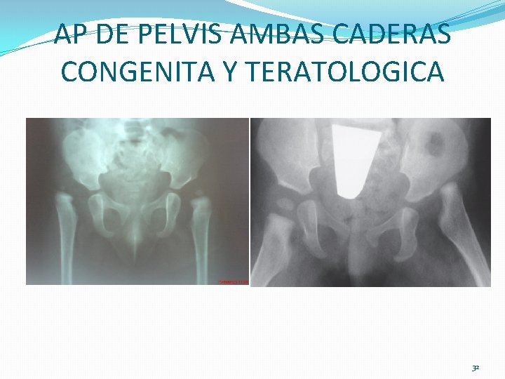 AP DE PELVIS AMBAS CADERAS CONGENITA Y TERATOLOGICA 32 AP DE PELVIS AMBAS CADERAS CONGENITA Y TERATOLOGICA 32